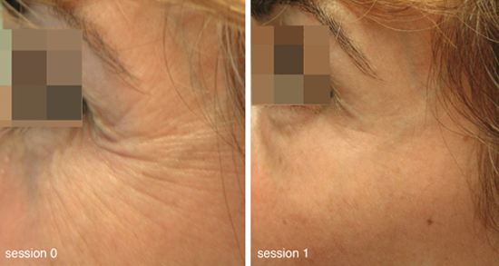 Hautverjuengung Anti Aging Faltenreduktion